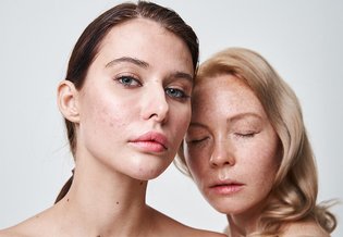  Dwie kobiety, jedna z problemami skórnymi: bliznami i przebarwieniami po trądziku.