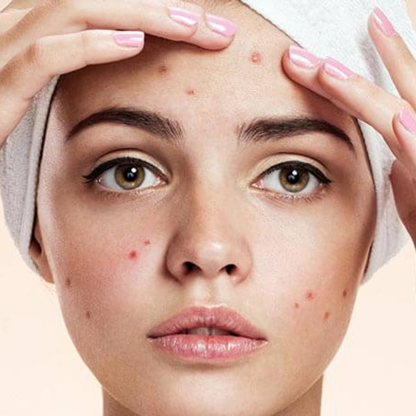 Pryszcze na twarzy i sposoby ich redukowania | 5 błędów w pielęgnacji twarzy, przez które masz trądzik młodzieńczy - La-Roche Posay