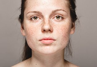 blizny po trądziku  - Jak usunąć blizny po trądziku i nieestetyczne przebarwienia skóry? | La Roche-Posay