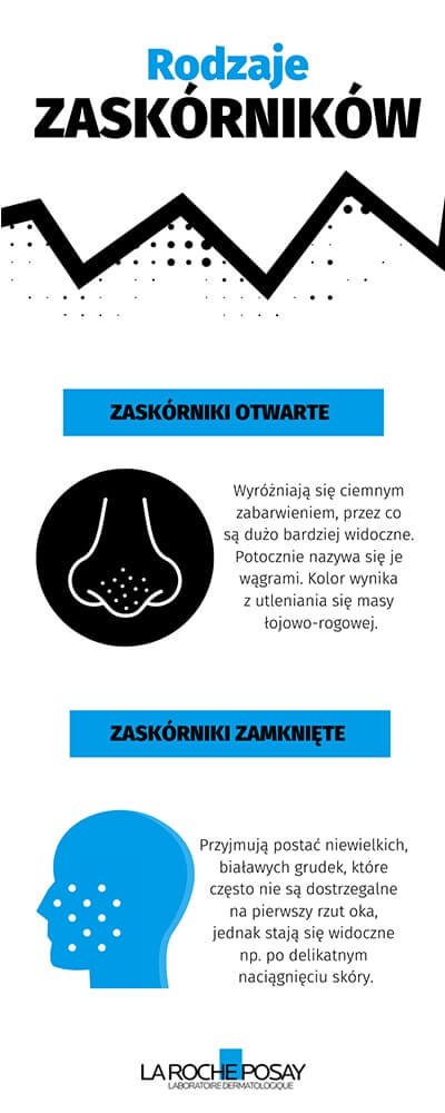 Infografika - rodzaje zaskórników | La Roche-Posay