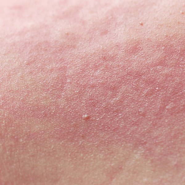 Wyyspka alergiczna |Alergia skórna - czyli jak radzić sobie z czerwonymi plamami na skórze? -  La Roche-Posay