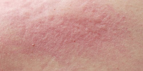 Alergiczna tyłko sucha skóra jest reaktywna | La Roche Posay