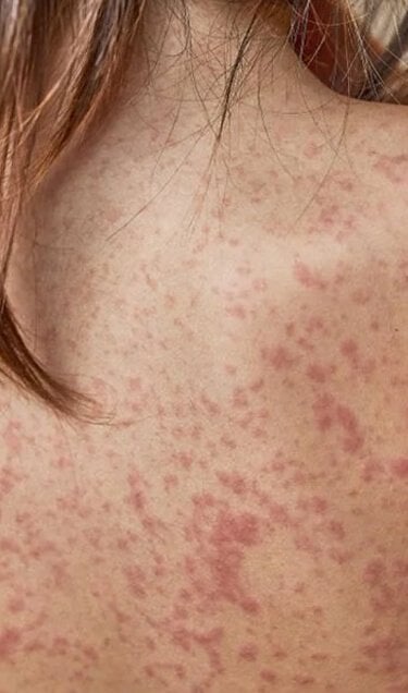 AZS u dzieci produkty La Roche-Posay