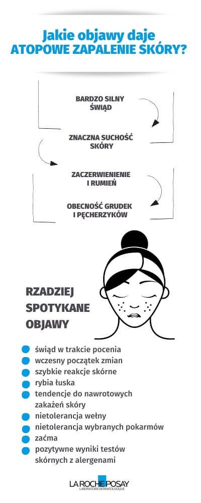  Objawy atopowego zapalenia skóry