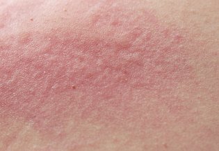 Alergiczna tyłko sucha skóra jest reaktywna 1 | La Roche Posay