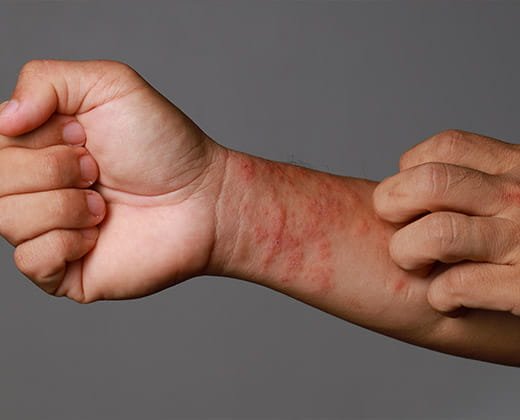 Objawy wysypki alergicznej – zdjęcia