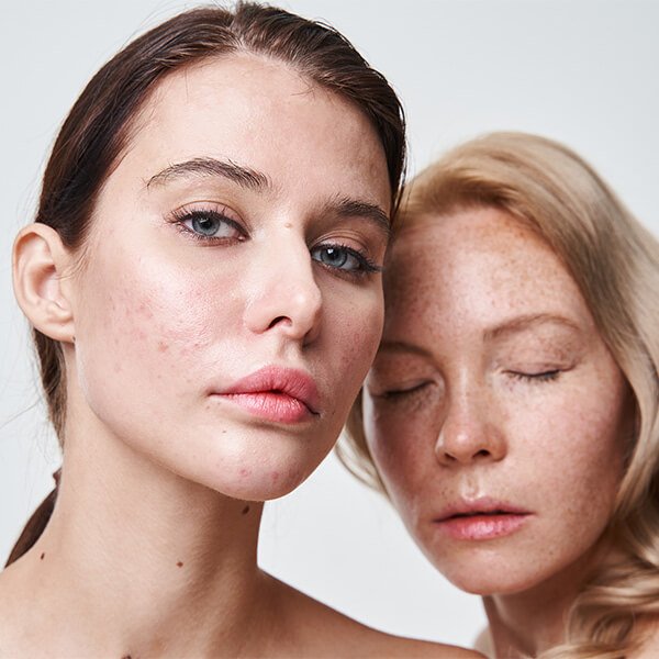 Dwie kobiety, jedna z problemami skórnymi: bliznami i przebarwieniami po trądziku.