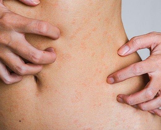 Ślady po ospie na brzuchu