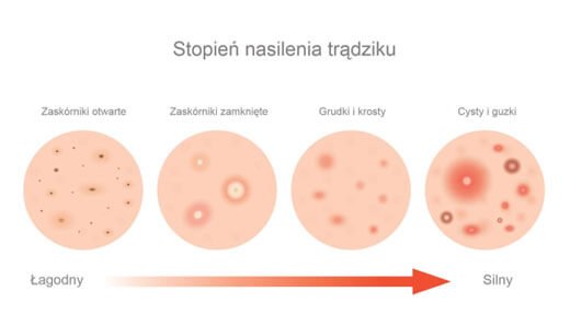 Stopień nasilenia trądziku: zaskórniki, grudki i krosty, cysty i guzko