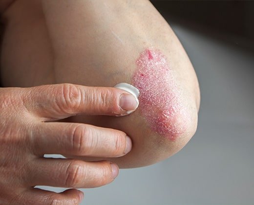 Aplikacja kremu na łuszczycę