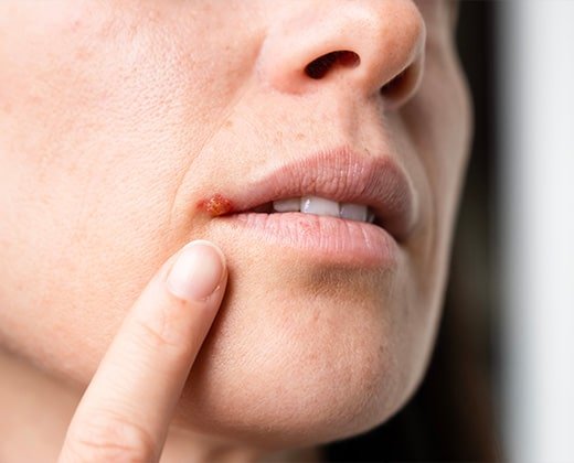Widoczna opryszczka na ustach