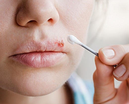 Kobieta aplikuje krem na opryszczkę