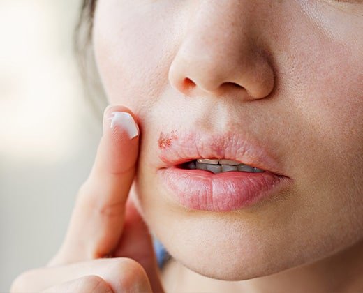 Pielęgnacja ust z opryszczką