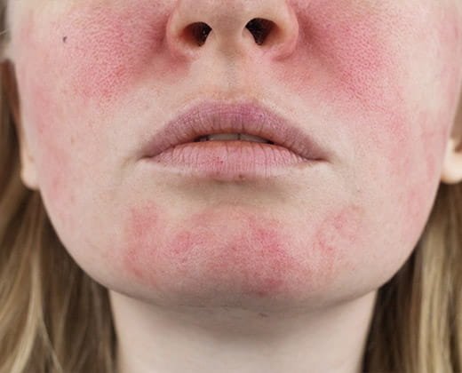 Zaczerwienienia skóry twarzy jako objaw trądziku różowatego
