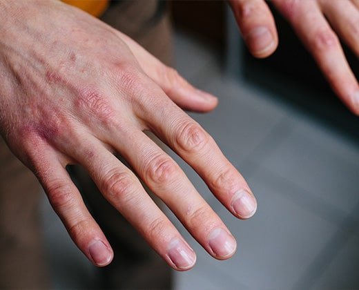 Objawy suchej skóry na dłoniach