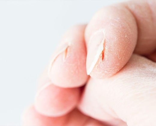 Pękająca skóra na palcach przy paznokciach