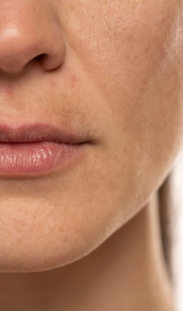 Plamy pigmentacyjne na twarzy – melasma