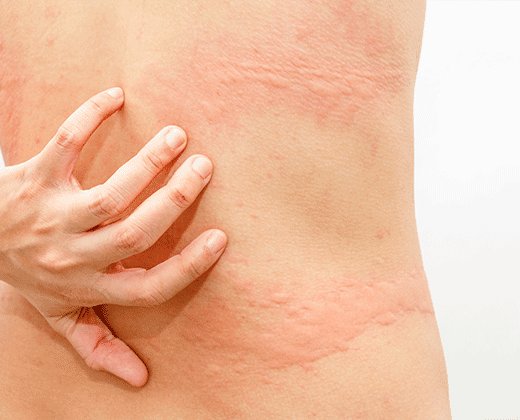 Objawy pokrzywki cholinergicznej na plecach