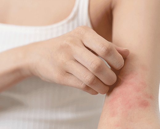 Objawy wysypki alergicznej, pokrzywki cieplnej na przedramieniu