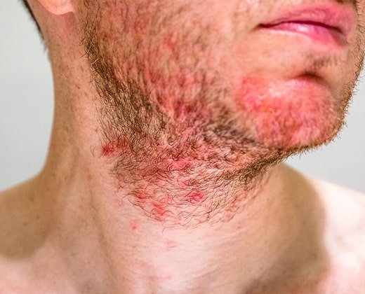 Objawy pokrzywki na twarzy u dorosłego mężczyzny