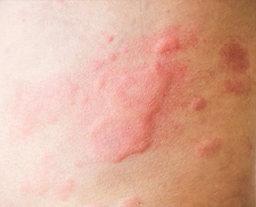 Fragment skóry z objawami pokrzywki słonecznej