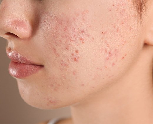 Twarz z widocznym trądzikiem