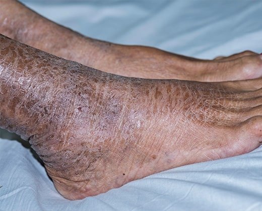 Objawy rybiej łuski na stopach