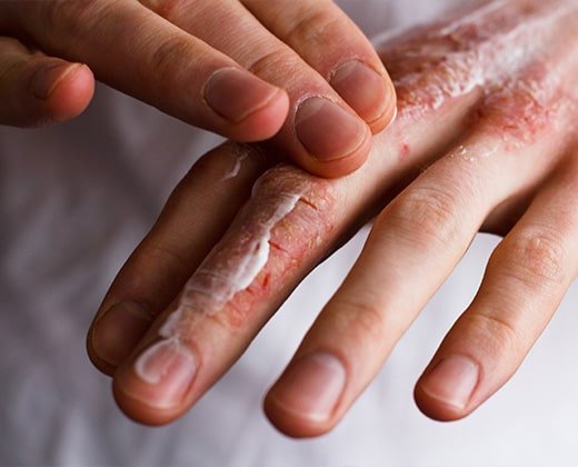 Pielęgnacja skóry dłoni z rybią łuską