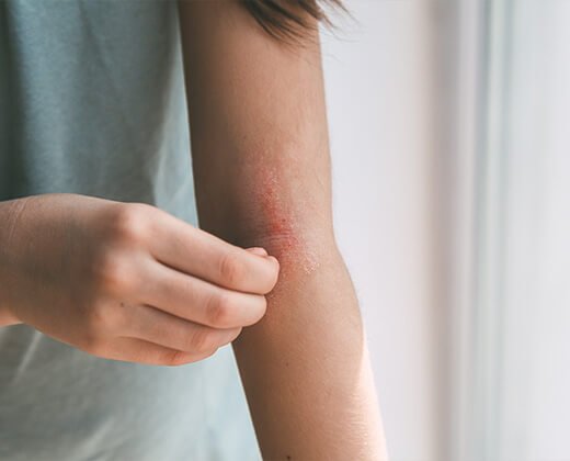 Kobieta drapiąca zmiany skórne w zgięciach łokci