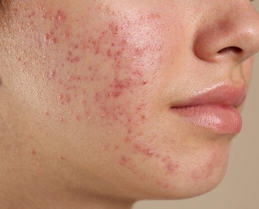 Trądzik hormonalny widoczny na kobiecej twarzy