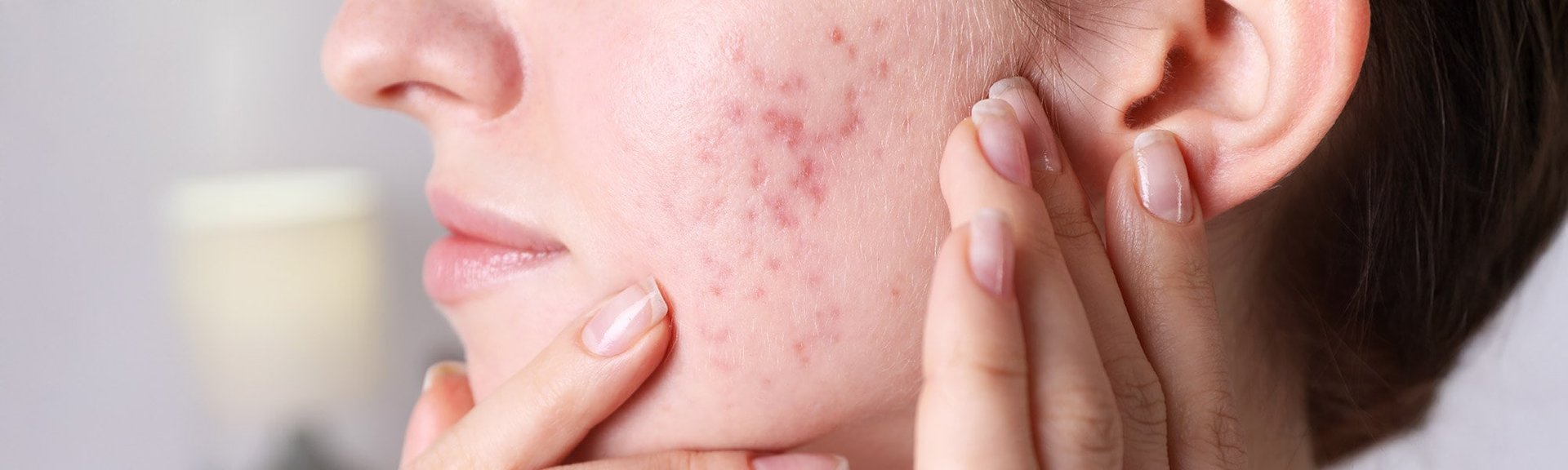 twarz z bliznami po trądziku hormonalnym
