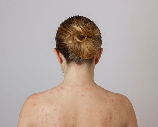 Pielęgnacja skóry z trądzikiem na plecach