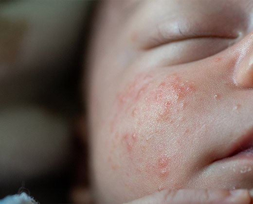 Objawy trądziku niemowlęcego na policzkach