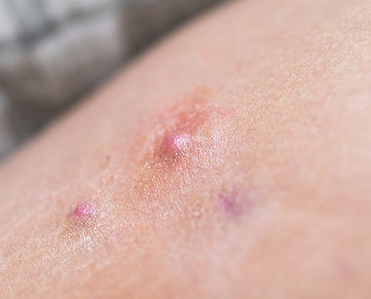 Objawy trądziku odwróconego