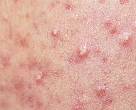 Sprawdź jak wygląda trądzik pospolity