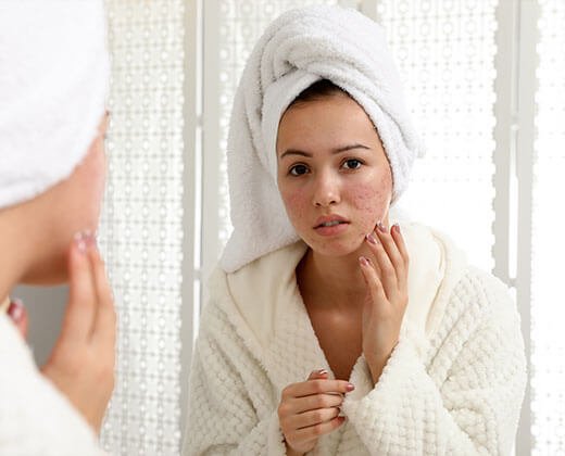 Kobieta z trądzikiem pospolitym na twarzy