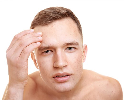 Cera trądzikowa mężczyzn pielęgnacja