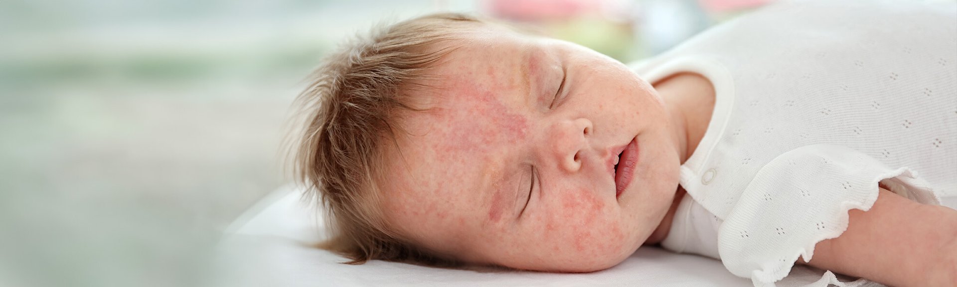 Uczulenie skórne u dziecka i jak sobie z nim radzić? | La Roche Posay