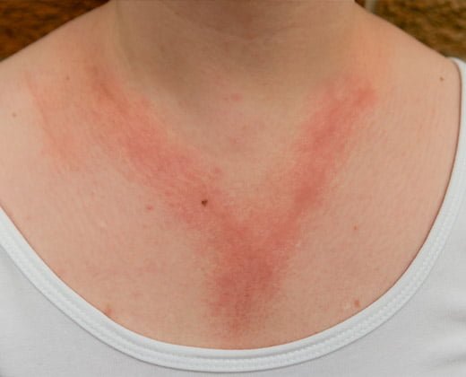 Objawy wyprysku kontaktowego alergicznego na dekolcie