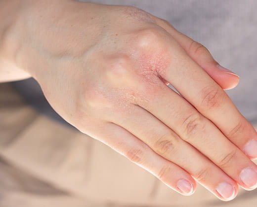 Wyprysk kontaktowy z podrażnienia