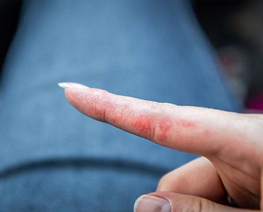 Wyprysk potnicowy na palcach