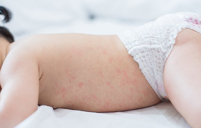 Wysypka u niemowlaka