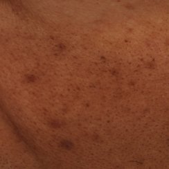 skóra przed stosowaniem Mela B3 serum