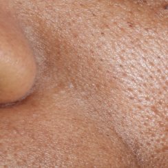 skóra przed stosowaniem Mela B3 serum