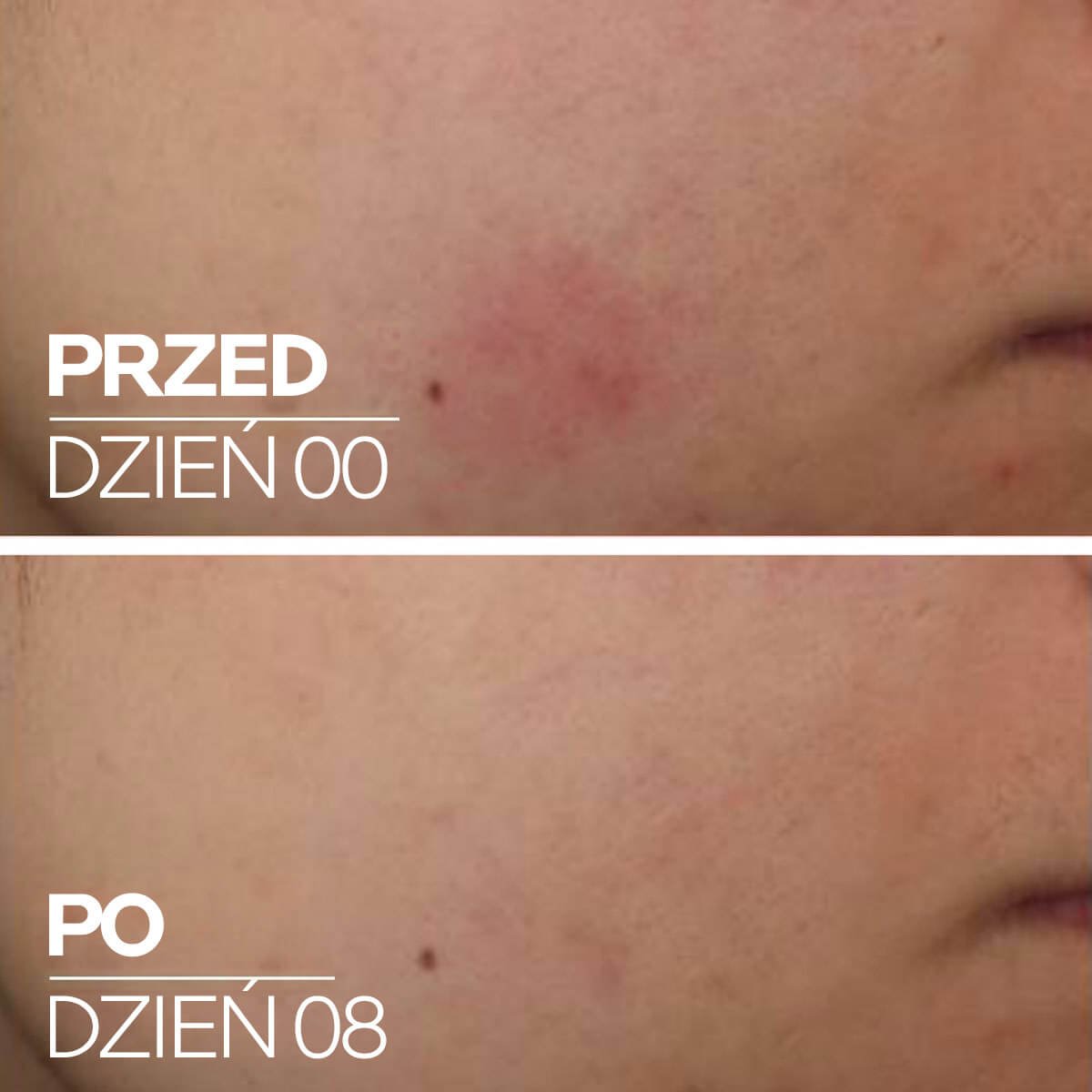 Cicaplast Serum B5 - przed i po